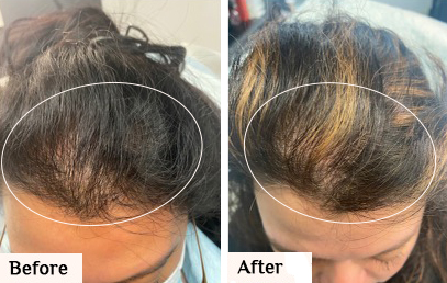 Before & After prp hair restoration